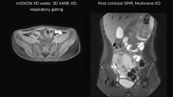 Crohn&rsquo;s disease in the terminal ileum