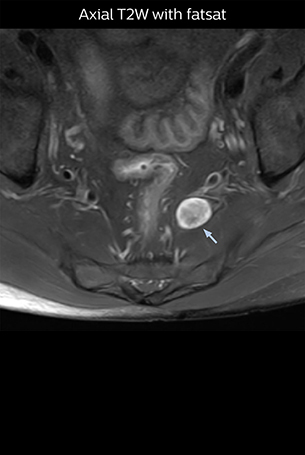Axial T2W with fatsat